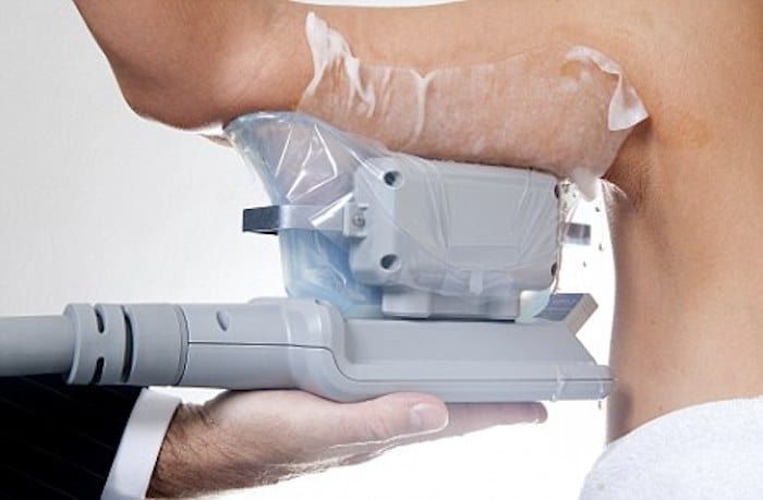 fat freezing arms Bellshill