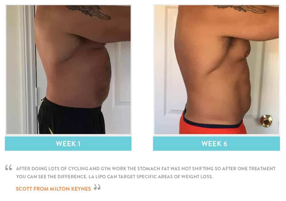 Before & After Stomach Fat Bellshill