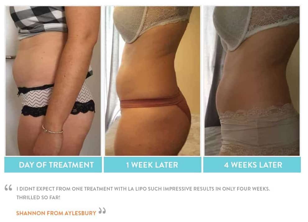 before, Cryolipolysis Bellshill