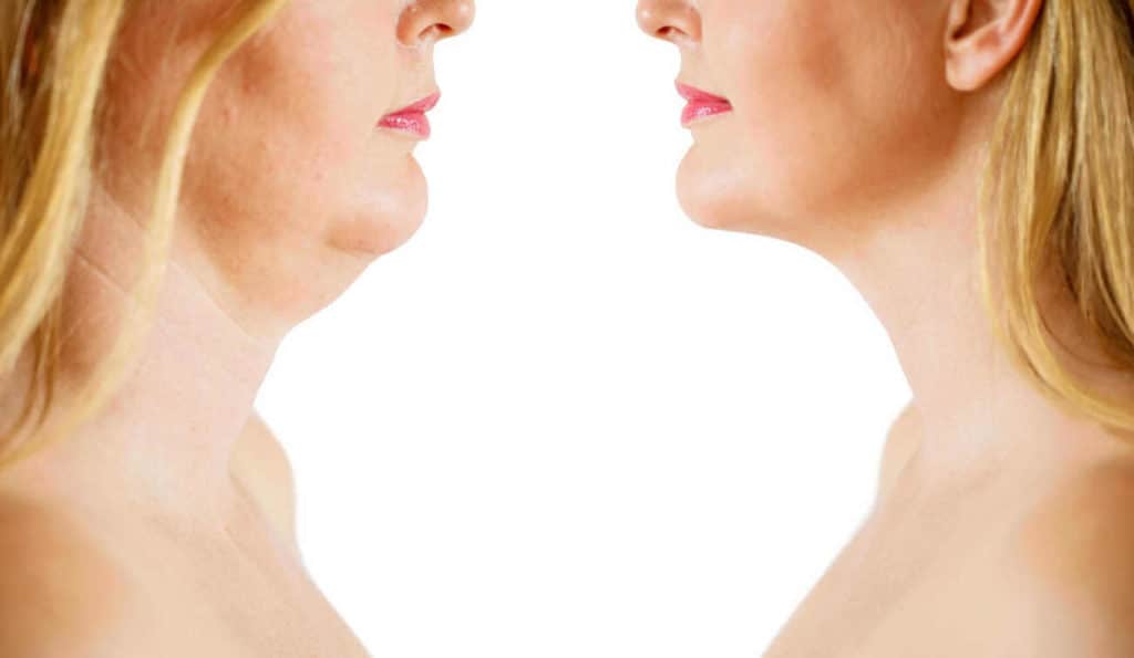 Double Chin treatment Bellshill before and after results