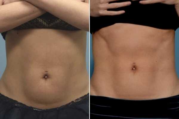 body sculpting FAQs Bellshill