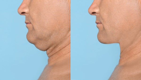 Which Non-Surgical Treatments Work Best for Jowls and Loose Skin Bellshill?