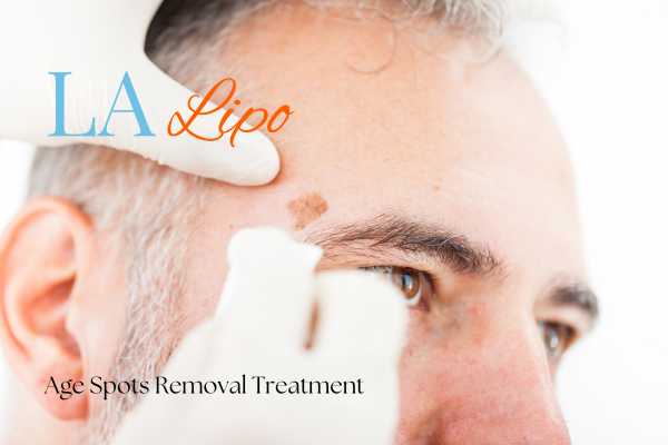What Are the Most Effective Treatments for Age Spots Bellshill?