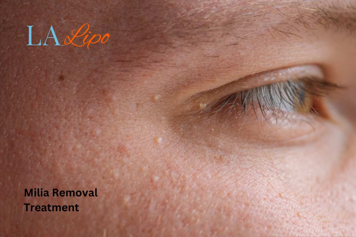 Cryopen Milia Removal: Is It the Easiest and Safest Option Bellshill?