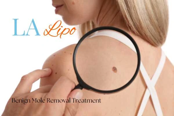 Woman having her inspection of blemish before mole removal Bellshill