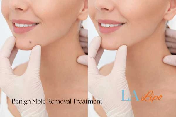 woman's before and after mole removal Bellshill results
