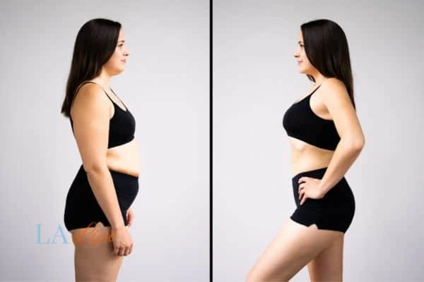 image of woman before and after results of LA-EMS Body Sculpting Bellshill to help treat Diastasis recti