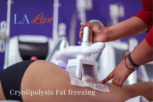 women getting fat freezing Bellshill