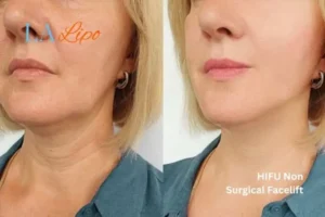 hi-fu for wrinkles Bellshill before and after results