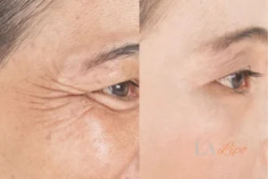 Before and after results of woman - HI-fu wrinkles reduction treatment Bellshill