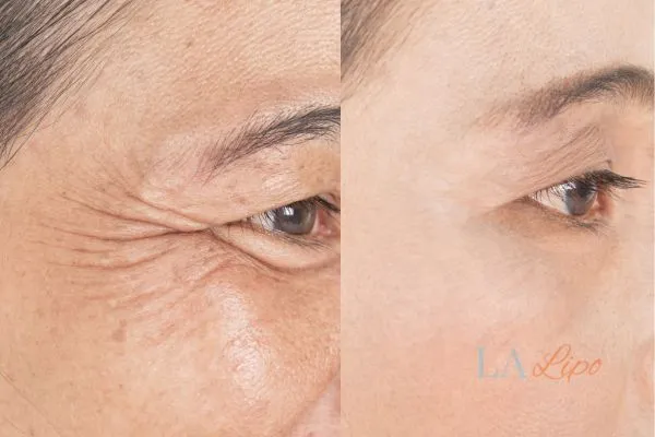 Before and after results of woman - HI-fu wrinkles reduction treatment Bellshill