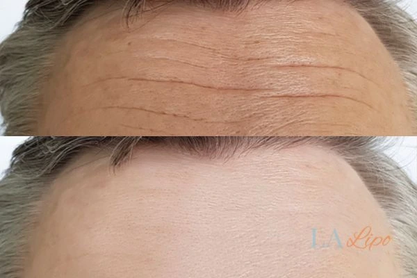 results of HIFU Bellshill on mans forehead to help reduce lines and wrinkles