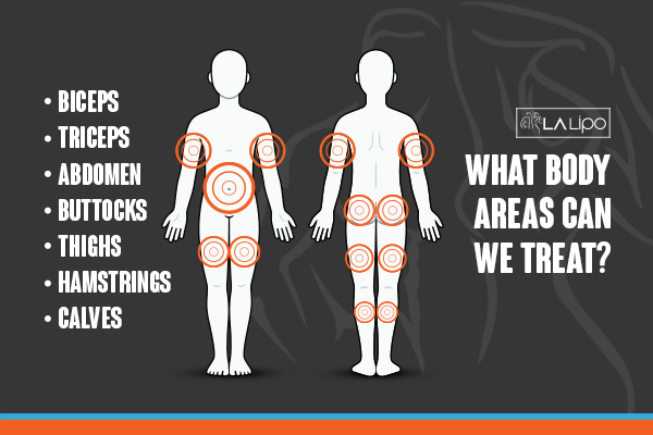 Graphic to show areas you can have LA-EMS Body Sculpting Bellshill treatment.