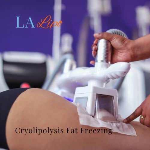 fat freezing - Cryolipolysis Bellshill