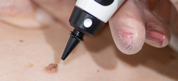 skin tag removal using cryopen Bellshill