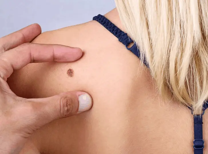 woman having mole removal Bellshill consultation before treatment.