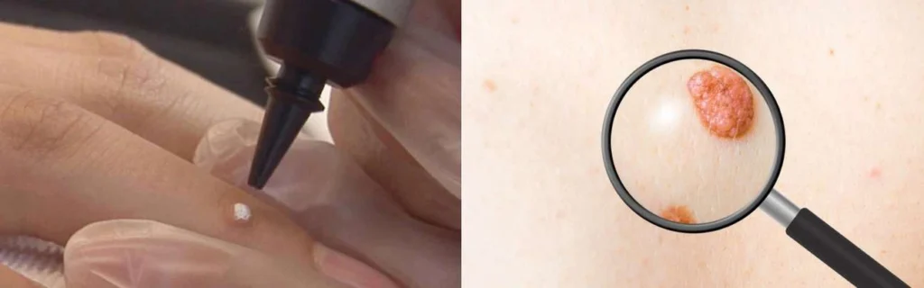 CryoPen practitioner Bellshill assessing a benign mole before treatment