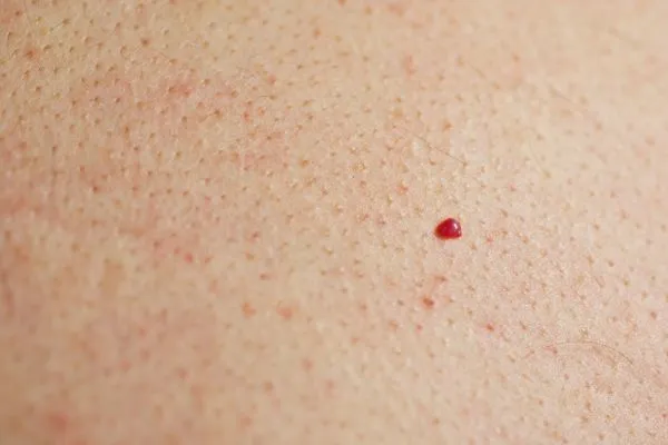 close up of a cherry angioma Bellshill