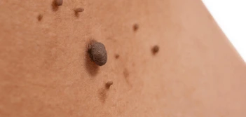 image of a skin tag Bellshill