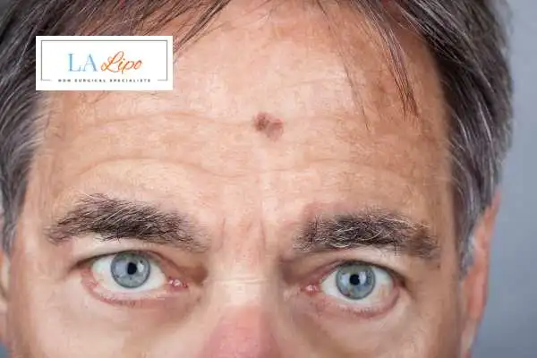 Solar Lentigo Removal Bellshill image of man with mark on his forehead