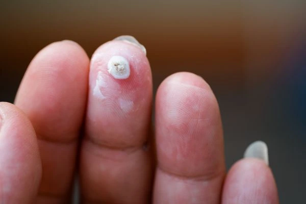 wart on person finger - cryotherapy to treat from LA LIPO Bellshill