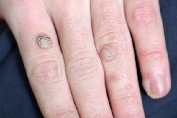 photo of warts on person hand - see wart removal Bellshill from LA LIPO