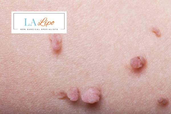 Does cryopen skin tag removal Bellshill hurt? Find out now call our team today!