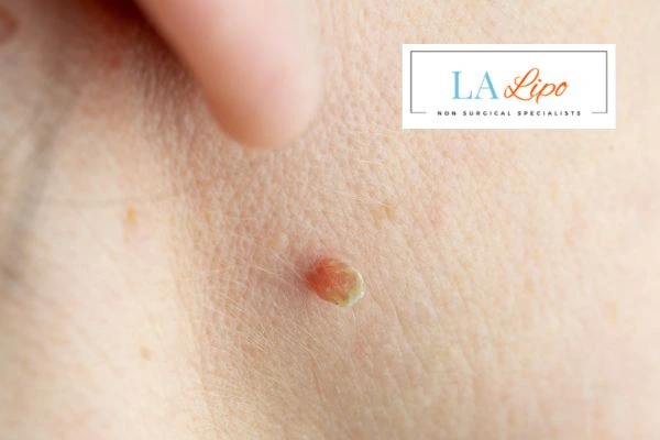 Book skin tag removal Bellshill today speak to our team now!