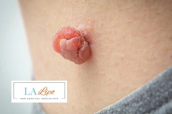 Interested in skin tag removal Bellshill? Concerned about the pain? Find out more today!