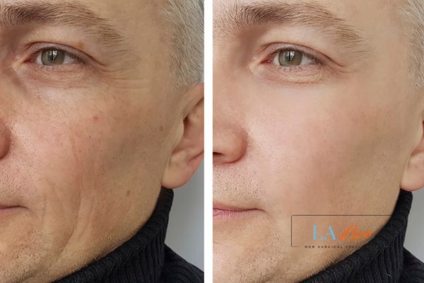 See the amazing results of Morpheus8 Treatment Bellshill!