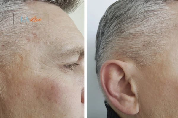 Mens Before & After Morpheus 8 Results Bellshill