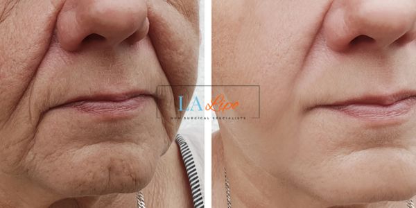 Older lady deeper wrinkle reduction - LA LIPO Morpheus 8 Results Bellshill