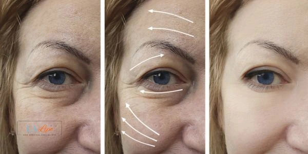 Amazing eye lift Morpheus 8 results Bellshill