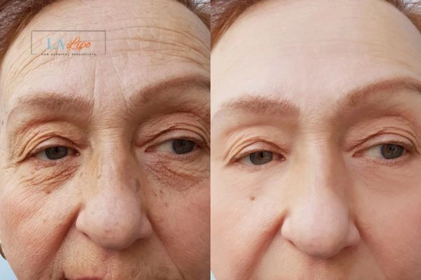 The powerful benefits of Morpheus8 Treatment Bellshill - Call Our team today!