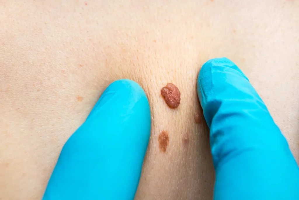 LA LIPO Cryopen Lesion Removal Prices Bellshill