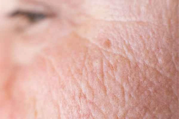 close up picture of a woman's face showing an age spot Bellshill