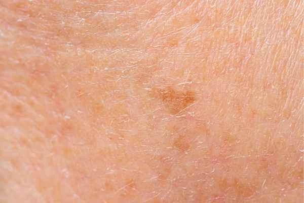 close up picture of age spots Bellshill