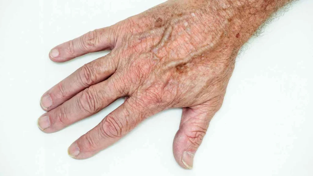 Male hand showing age spot Bellshill