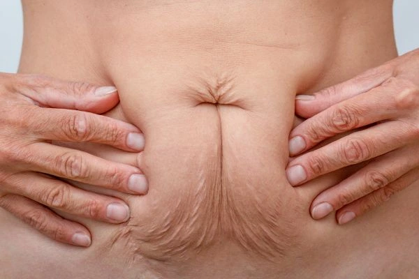 Image of a woman's stomach with loose skin - example of skin tightening Bellshill options