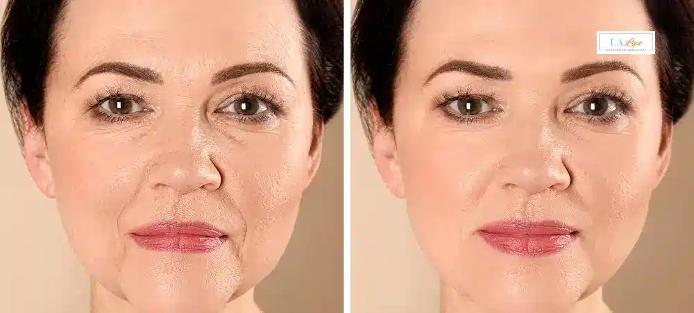 How Long Does It Take to See Results and How Long Do They Last Bellshill?