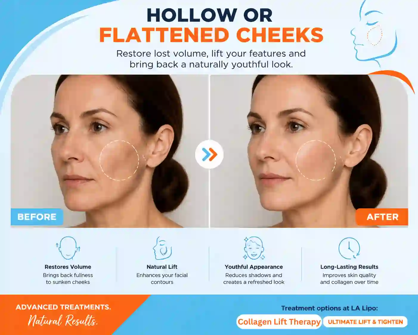 Sign #4: Hollow or Flattened Cheeks Bellshill