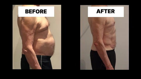 What Symptoms Can Diastasis Recti Cause in Men? Weak Core, Back Pain and Poor Posture Bellshill